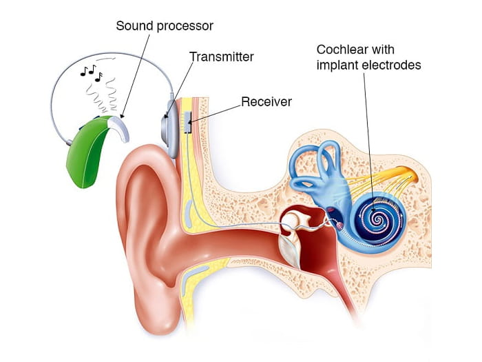 Cochlear Implant Diagram