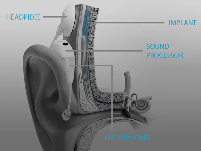 Cochlear Implant Diagram